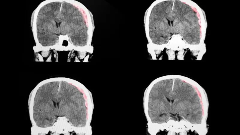 A traumatic brain injuried patient with large left subdural hematoma and moderate severe degree of brain edema.